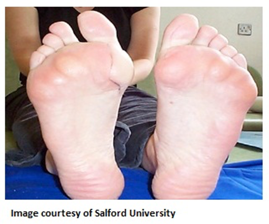 Rheumatoid Arthritis Foot Pain Relief Medicine